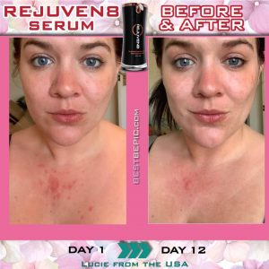 Rejuven8 Effect: before and after (USA)