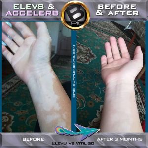 Elev8-Acceler8 vitiligo