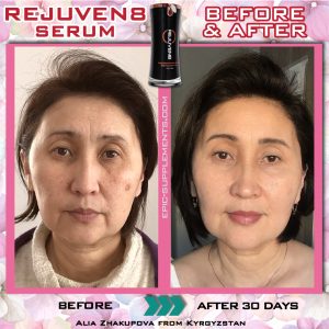 Rejuven8 Effect: before and after