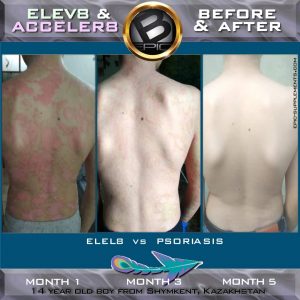 Bepic elev8 againts psoriasis review