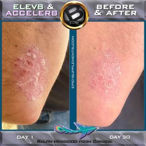 B-Epic 3-pills-system for psoriasis (before and after pics))