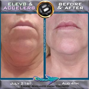 Face lifting with b-epic 3 pills