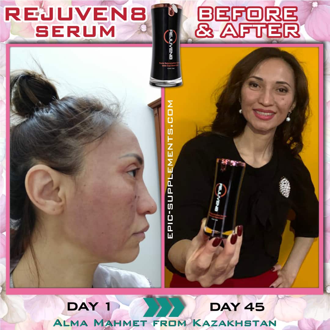 BEpic Rejuven8 for face redness (real photos)