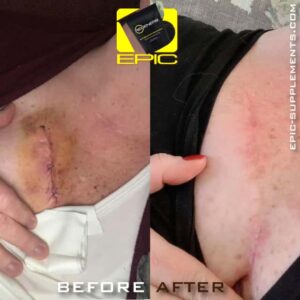 Wound recovery with Bepic Regener8